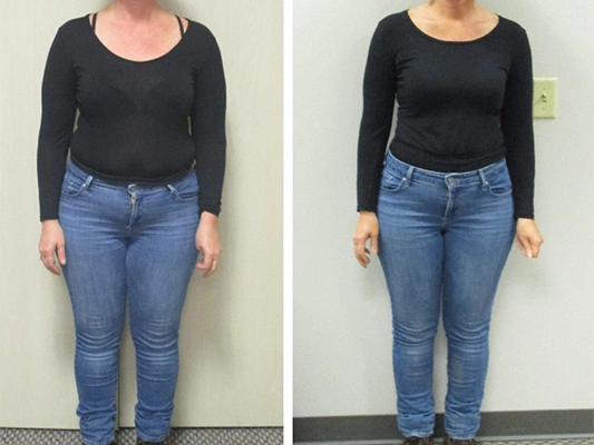 Weight Loss Kenosha WI Before And After