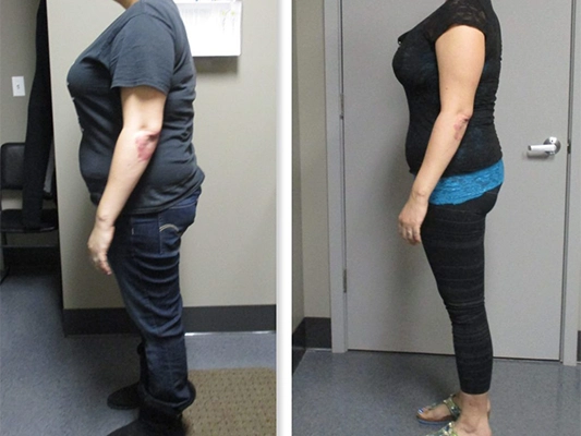 Weight Loss Kenosha WI Before And After